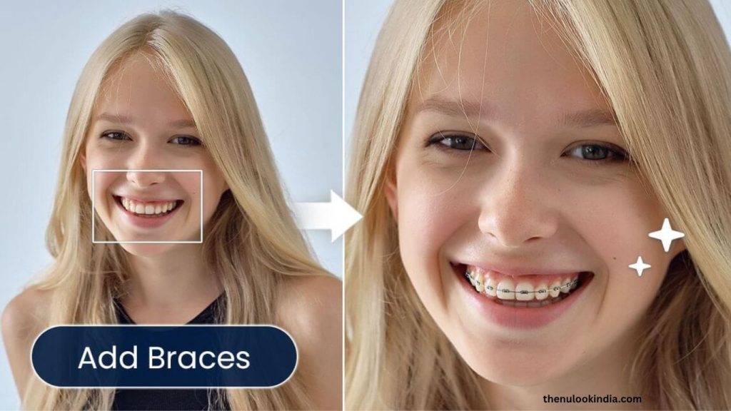Braces Filter